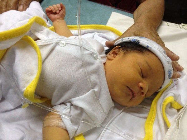 Thay máu sơ sinh ở trẻ bị vàng da bệnh lý