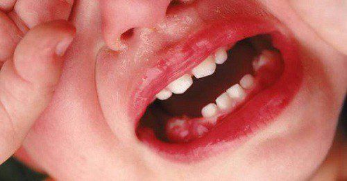 Cách chăm sóc nướu và răng mới mọc của bé
