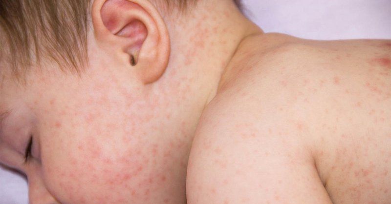 Một số biến chứng của sốt phát ban ở trẻ