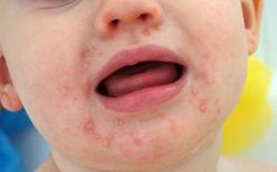 Chăm sóc và vệ sinh miệng của trẻ đang bị tay chân miệng