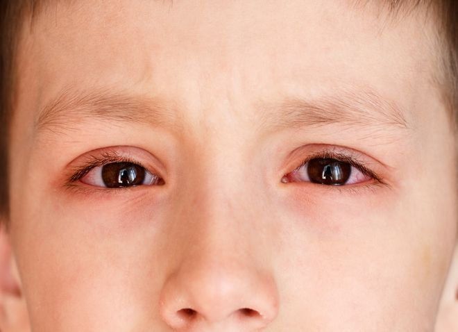 Nguyên nhân và diễn biến đau mắt đỏ ở trẻ em