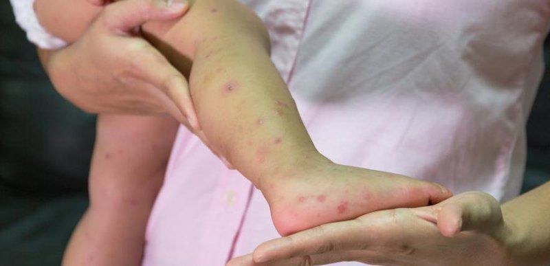 Biểu hiện tay chân miệng theo từng giai đoạn ủ bệnh - khởi phát - toàn phát