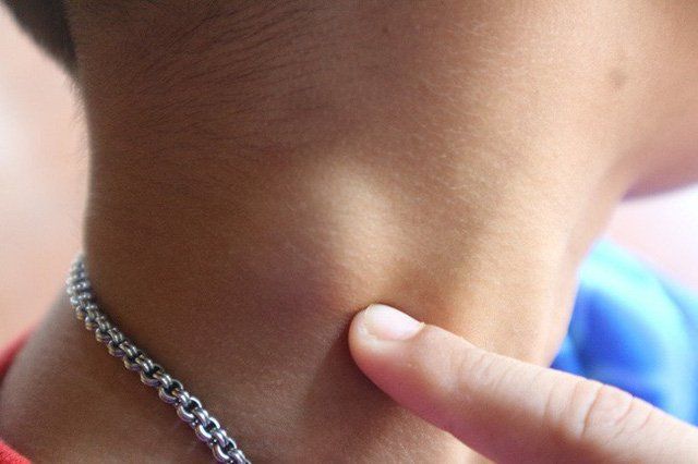 Sưng các hạch và tuyến ở trẻ em