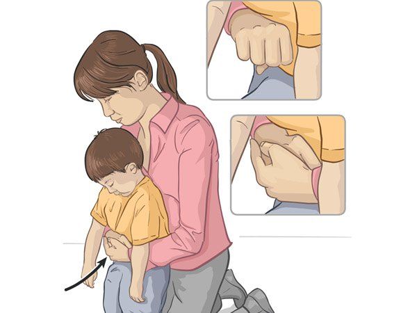 Sơ cứu khi trẻ bị ngạt đường thở do dị vật