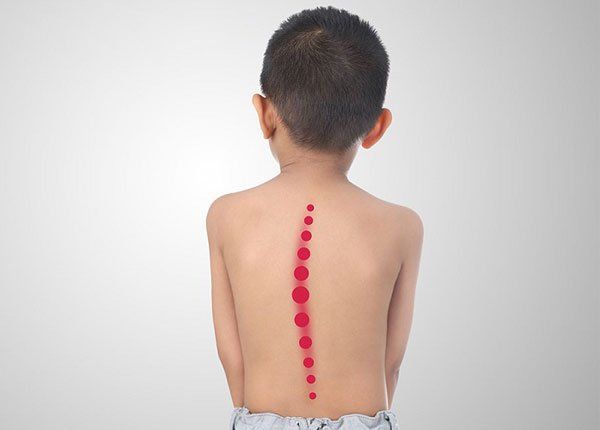 Dấu hiệu phát hiện cong vẹo dị tật cột sống bẩm sinh