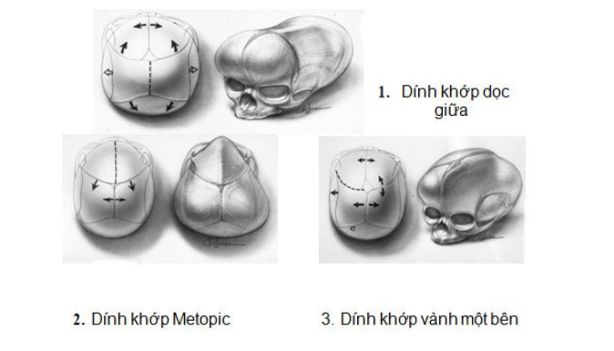 Các loại dính khớp sọ thường gặp ở trẻ em