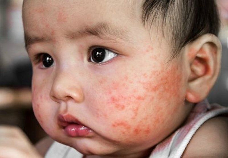 Vì sao bé bị chàm sữa (lác sữa)?
