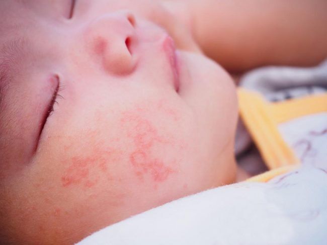 Các dạng viêm da dị ứng ở trẻ nhỏ