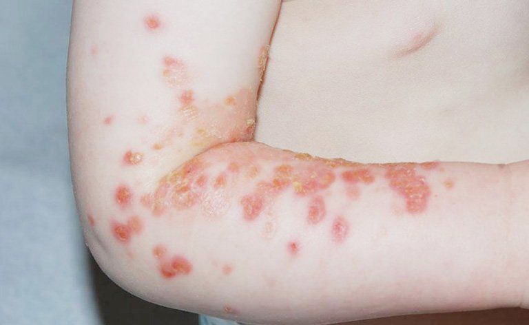 Nhận biết dấu hiệu bệnh chốc lây ngoài da ở trẻ nhỏ