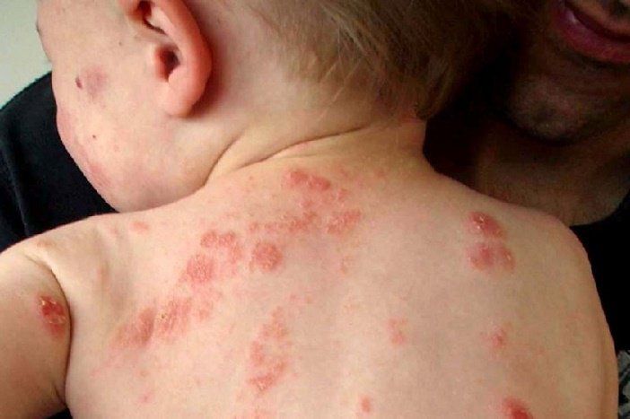 Trẻ bị chốc lây ngoài da: Phải làm sao?