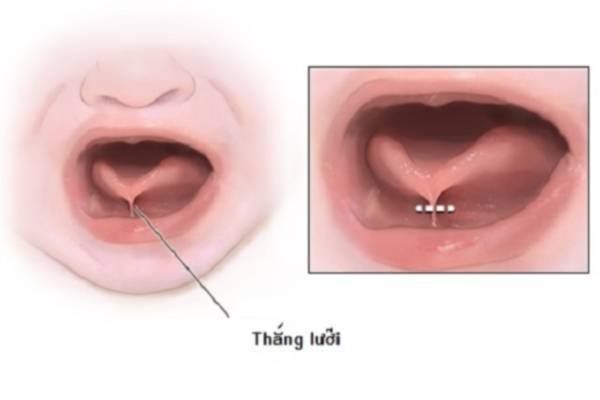 Xử trí tật dính thắng lưỡi ở trẻ nhỏ