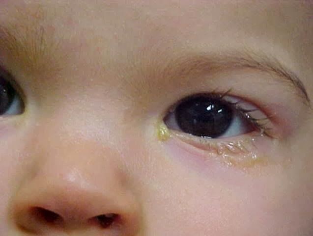 Xử trí khi trẻ sơ sinh bị tắc lệ đạo