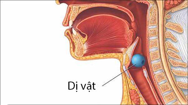 Sơ cứu khi trẻ bị ngạt đường thở do dị vật