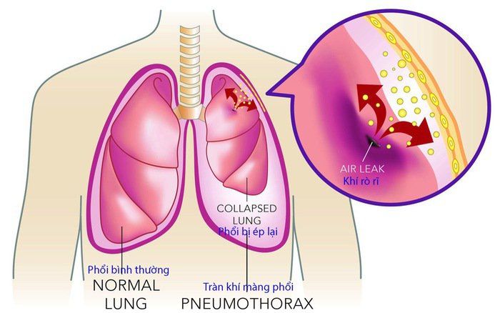 Sơ cứu khi trẻ bị ngạt đường thở do dị vật