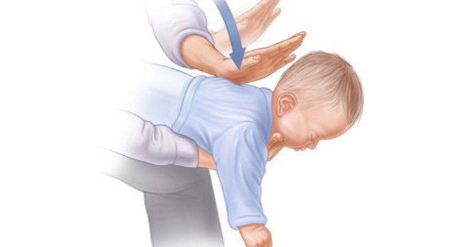 Tránh các sai lầm sau khi xử lý trẻ hóc dị vật