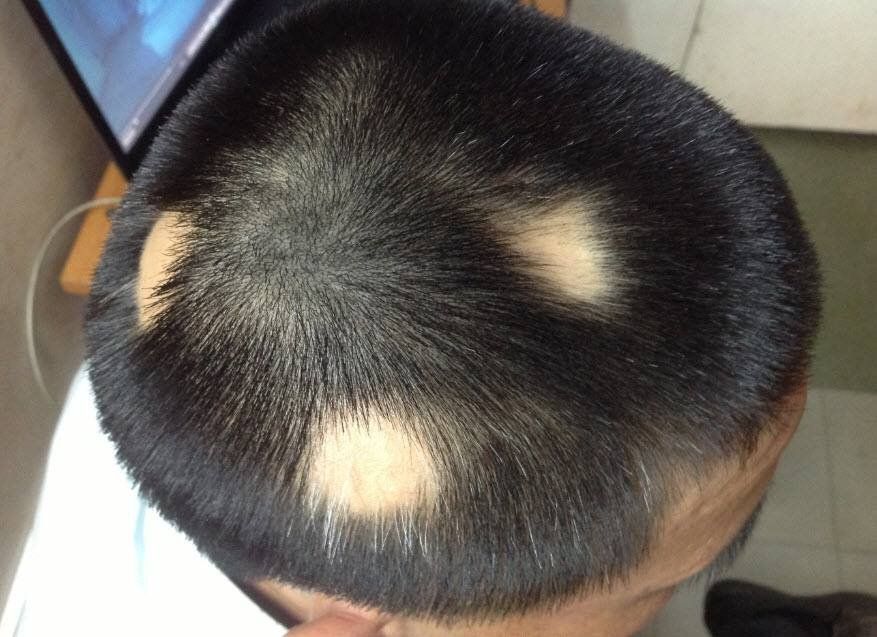 Rụng tóc từng mảng có đáng ngại?