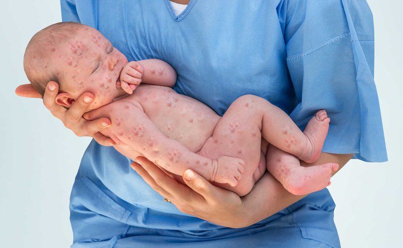 Bệnh ban đào ở trẻ em: Những điều cần biết
