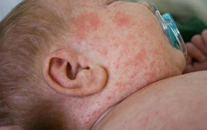 Bảo vệ trẻ sơ sinh khỏi dịch sốt xuất huyết