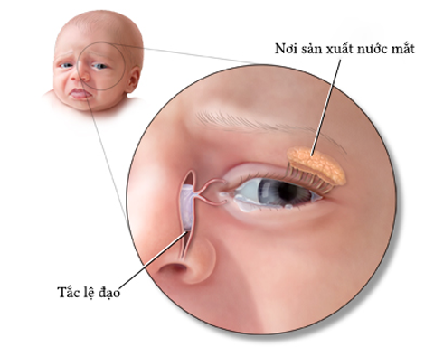 Nhận biết tắc lệ đạo ở trẻ sơ sinh