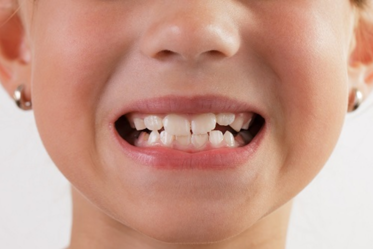 Cách giúp trẻ đỡ nghiến răng khi ngủ