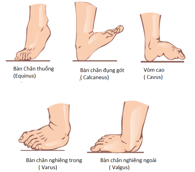 Dị tật bàn chân vẹo ở trẻ em