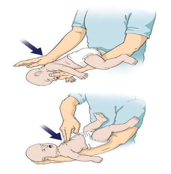 Cảnh giác trẻ bị sặc đờm dãi khi ho, sốt