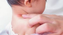 Cách xử trí khi trẻ bị zona