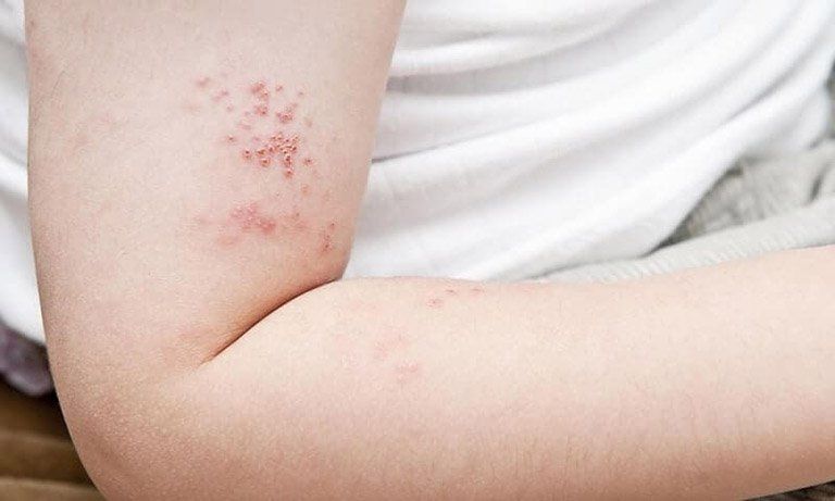 Zona ở trẻ em có nguy hiểm?