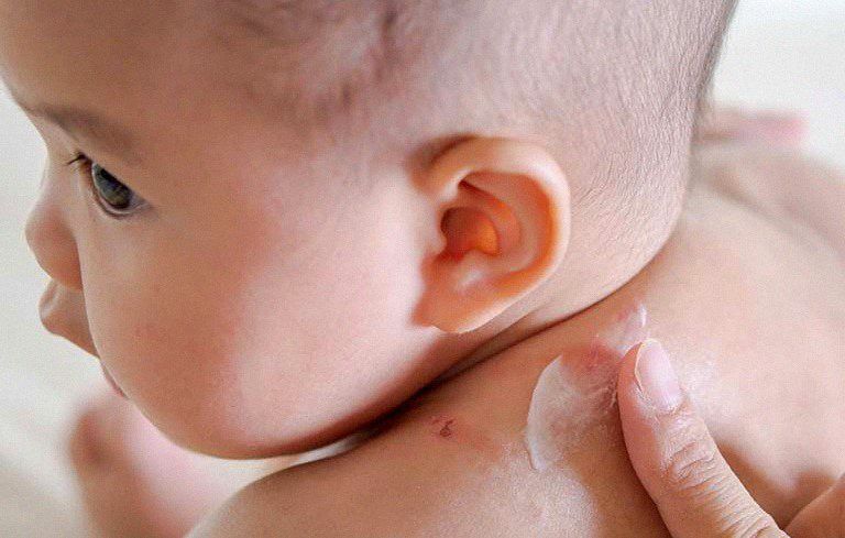 Dưỡng ẩm cho người viêm da cơ địa