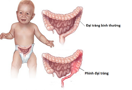 Phình đại tràng bẩm sinh ở trẻ: Nguyên nhân và dấu hiệu nhận biết