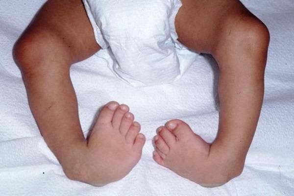 Điều trị và phục hồi chức năng cho trẻ có bàn chân khoèo