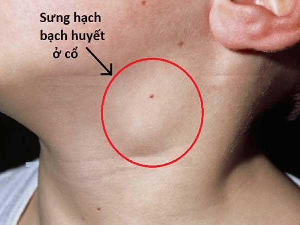 Sưng các hạch và tuyến ở trẻ em