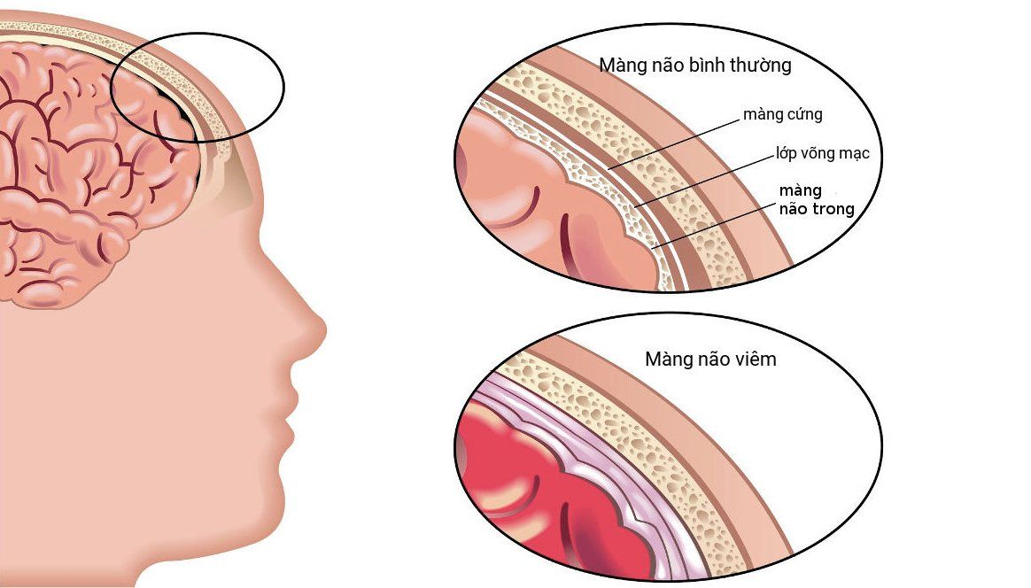 Viêm màng não mủ sơ sinh: Bệnh có nguy hiểm không