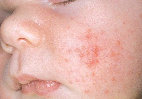 Mụn hạt kê (milia) ở trẻ sơ sinh có đáng ngại?