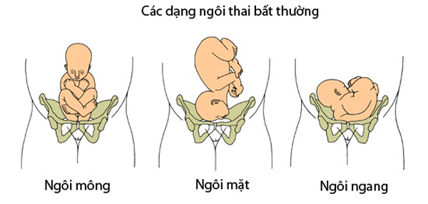 Xuất huyết não - màng sớm ở trẻ nhỏ