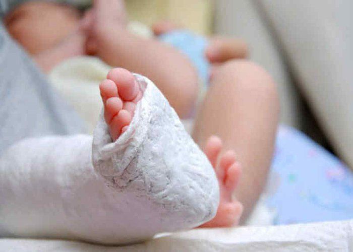 Điều trị trật khớp háng bẩm sinh ở trẻ thế nào?