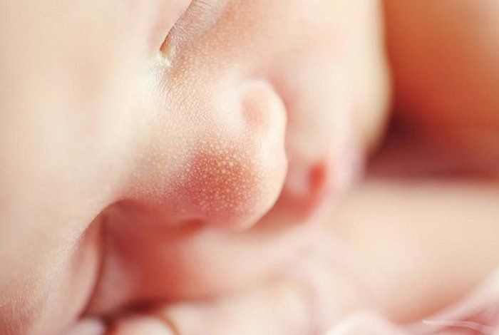 Cảnh giác với mụn bất thường ở trẻ sơ sinh