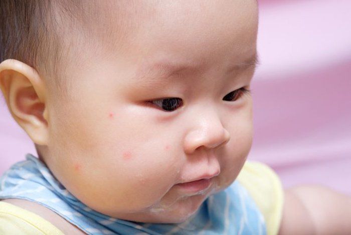 Cảnh giác với mụn bất thường ở trẻ sơ sinh