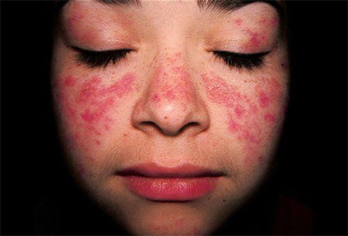 Các bệnh tự miễn thường gặp ở trẻ em