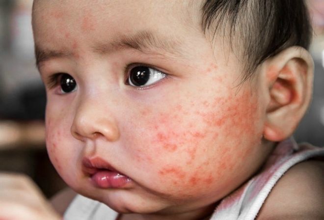 Nhận biết nhiễm trùng da ở trẻ sơ sinh