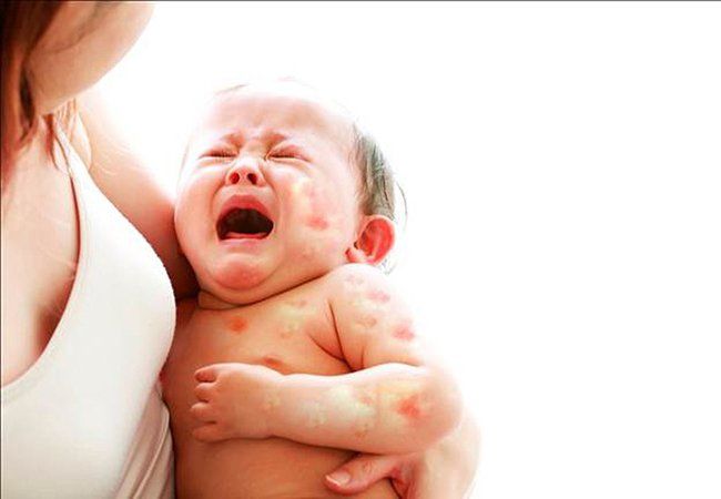 Nhận biết và xử trí dị ứng đạm sữa bò ở trẻ
