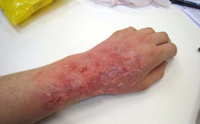 Sơ cấp cứu bỏng ở trẻ em