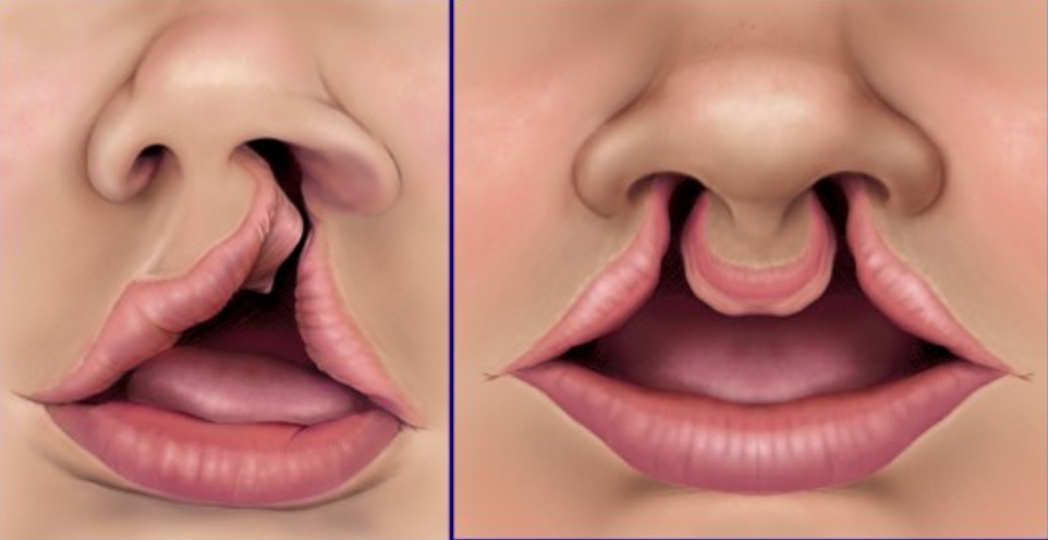 Khe hở môi hàm trên thường gặp bên nào?