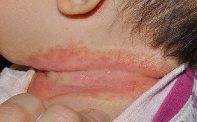 Chăm sóc trẻ bị phát ban nhiệt do nóng trong