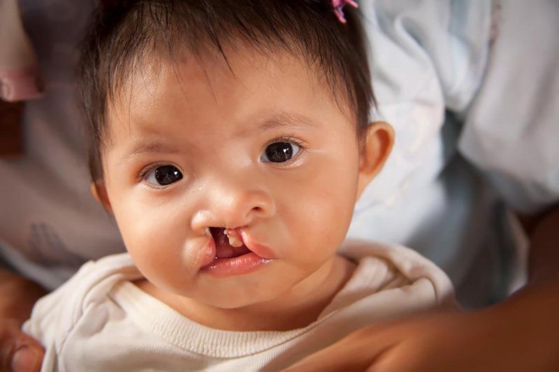 Thời điểm nào tốt nhất để phẫu thuật hở hàm ếch cho trẻ?