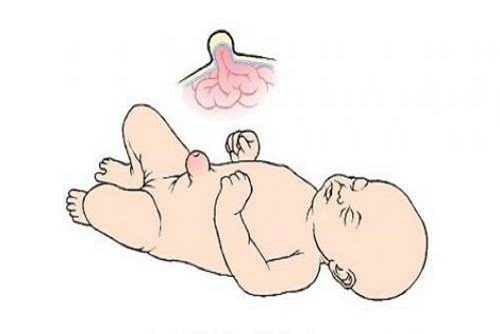 Rốn trẻ sơ sinh bị lồi: Sẽ tự khỏi hay cần điều trị?