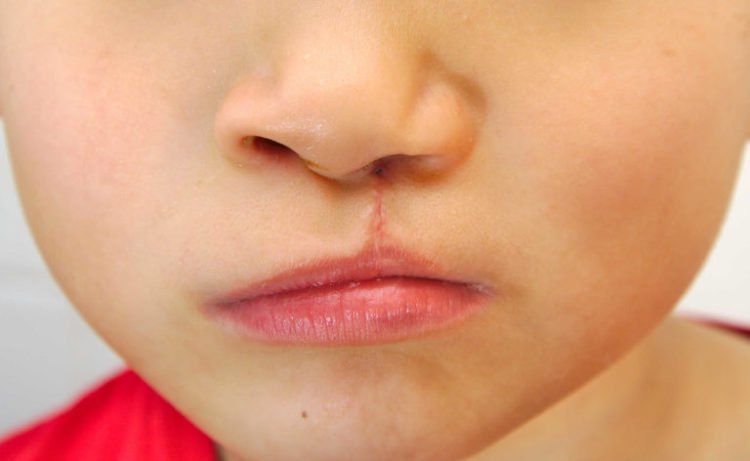 Chuẩn bị gì trước khi phẫu thuật hở hàm ếch cho trẻ?