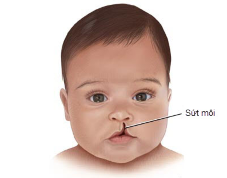 Chuẩn bị gì trước khi phẫu thuật hở hàm ếch cho trẻ?