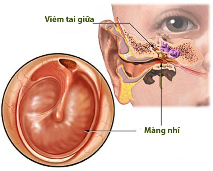 Vá nhĩ đơn thuần điều trị viêm tai giữa