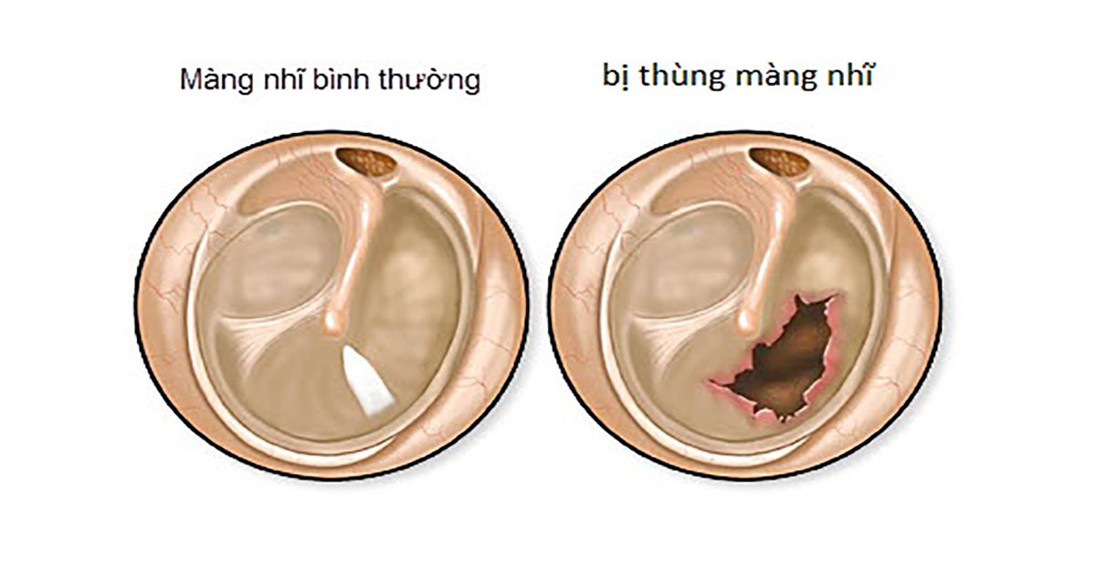 Vá nhĩ đơn thuần điều trị viêm tai giữa
